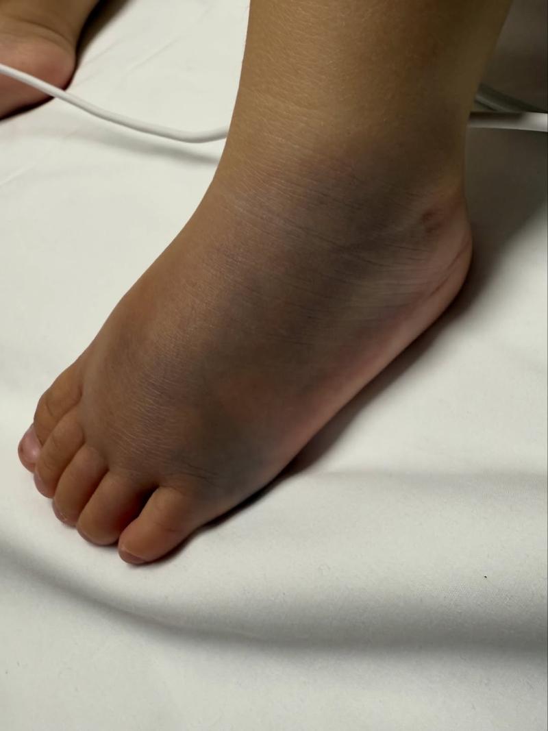 Tanza Valera muestra cómo se encontraba el pie de su hija | Instagram