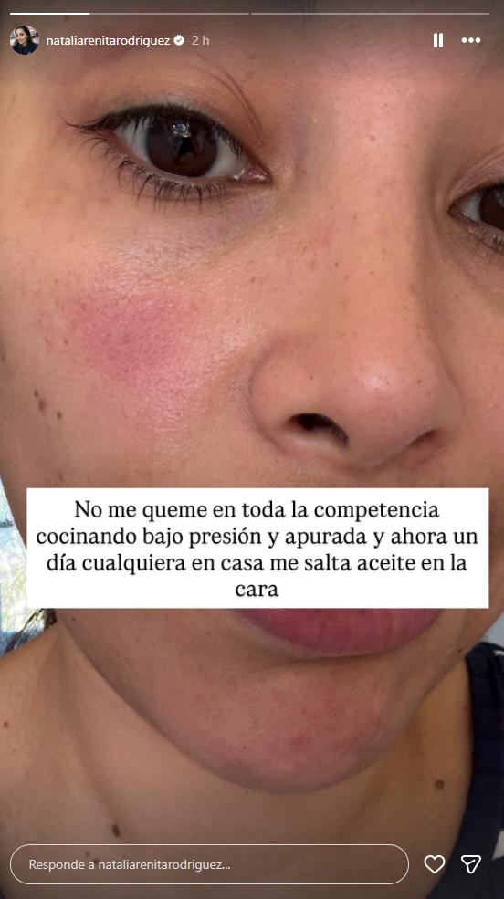 Natalia Rodríguez muestra cómo quedó su cara tras accidente doméstico | Instagram