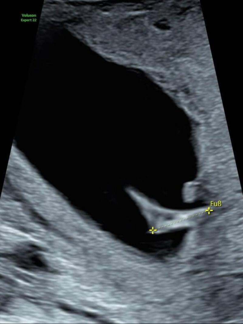 Actriz muestra ecografía de su segundo embarazo | Instagram