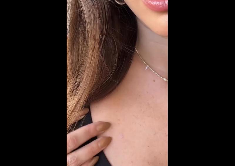 Así se veía el carcinoma de Coni Piccoli antes de la operación