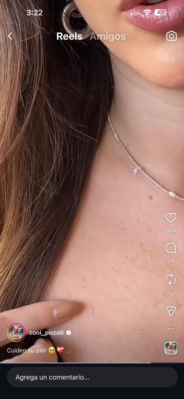 Coni Piccoli muestra donde tiene su herida | Instagram