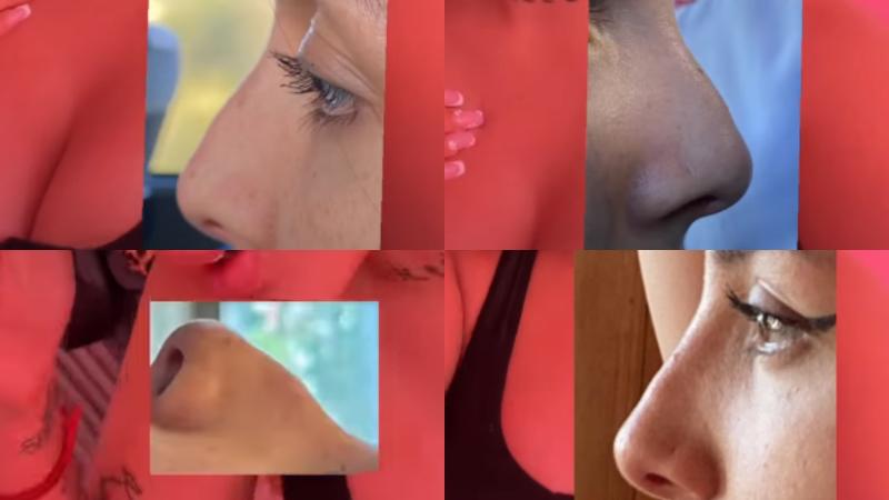 La Chilota mostró cómo era su nariz antes de la operación y solo con ácido hialurónico - Instagram