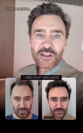 Jordi Castell muestra el antes y después de su implante capilar | Instagram