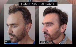 Jordi Castell muestra el antes y después de su implante capilar | Instagram