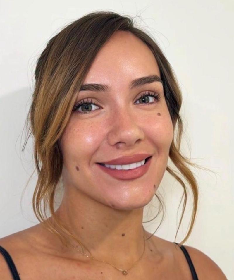 Valentina Concha antes de quitarse los dos lunares - Instagram