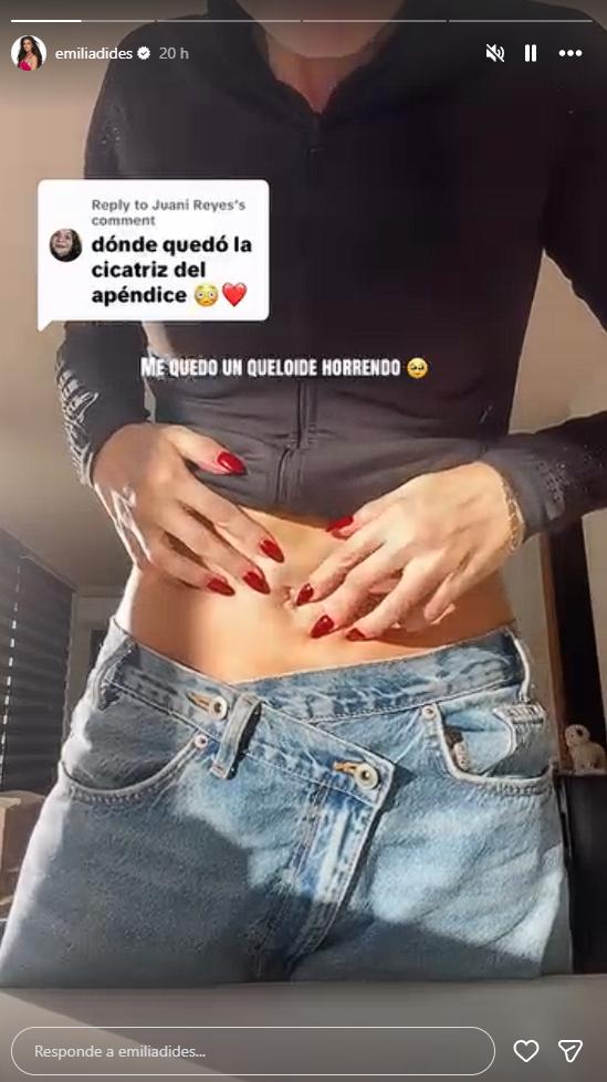 Emilia Dides muestra cicatriz por operación | Crédito: Instagram Emilia Dides