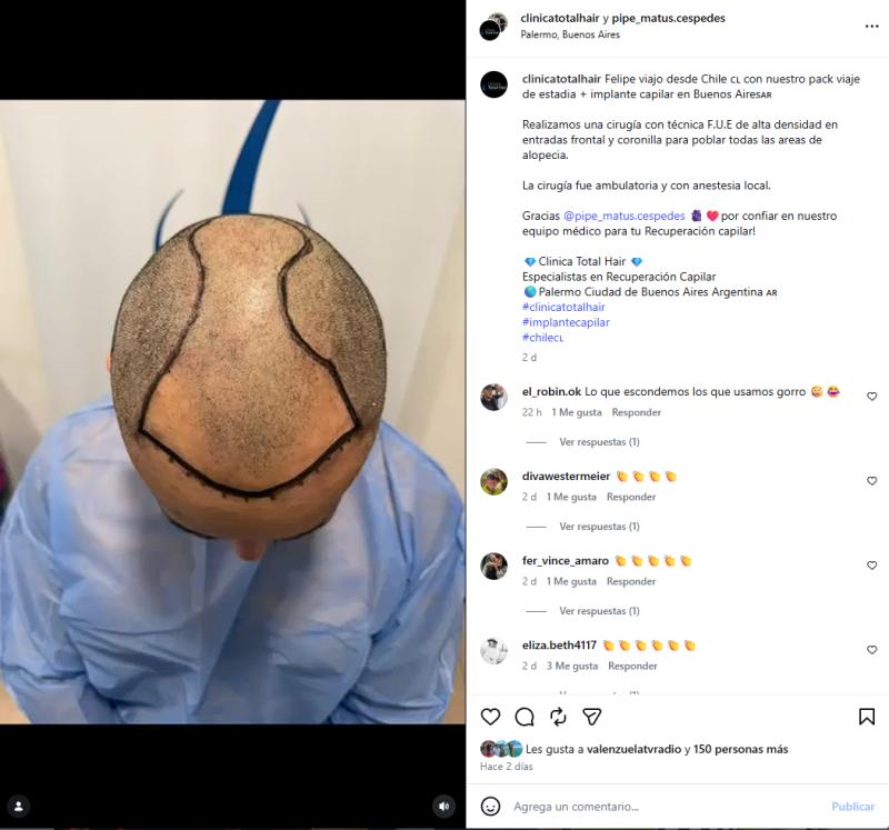 Hermano de Marité Matus se sometió a un procedimiento estético | Crédito: Instagram @ pipe_matus.cespedes