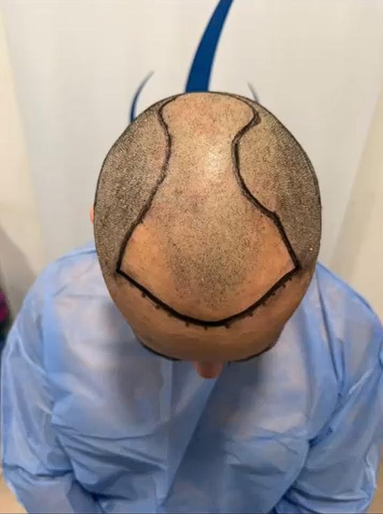 Hermano de Marité Matus se sometió a un procedimiento estético | Crédito: Instagram @ pipe_matus.cespedes