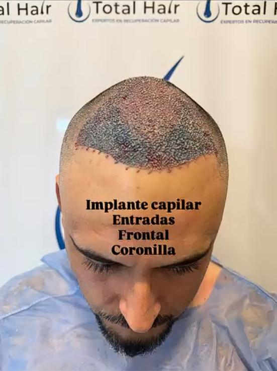 Hermano de Marité Matus se sometió a un procedimiento estético | Crédito: Instagram @ pipe_matus.cespedes