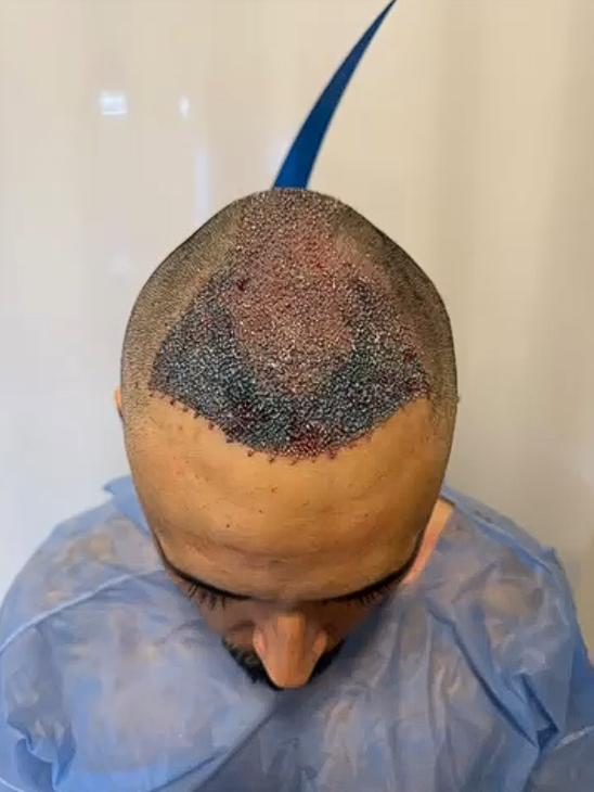 Hermano de Marité Matus se sometió a un procedimiento estético | Crédito: Instagram @ pipe_matus.cespedes