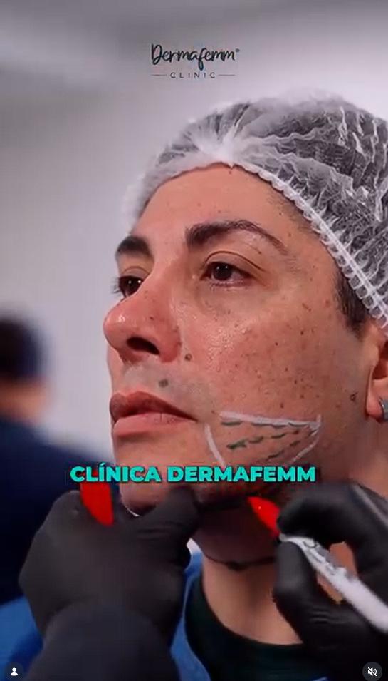 Botota Fox mostró su nuevo procedimiento en el rostro | Crédito: Instagram @dermafemm_clinic