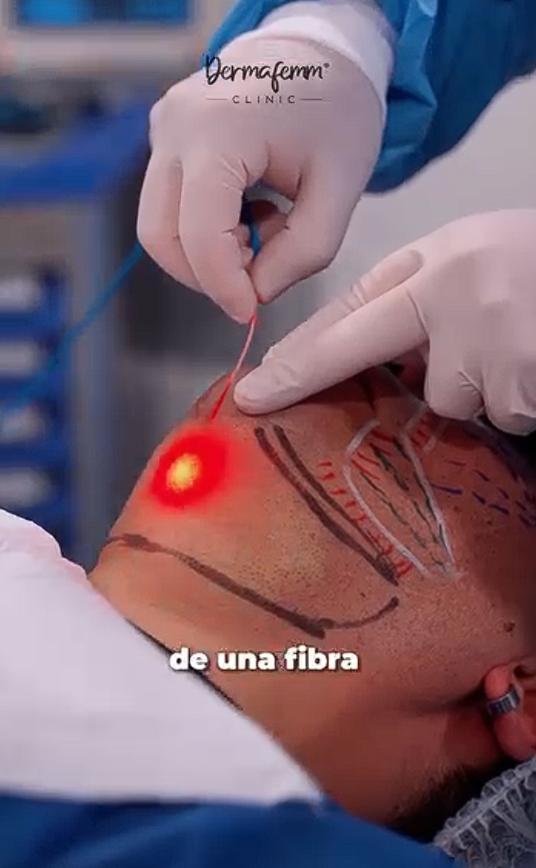 Botota Fox mostró su nuevo procedimiento en el rostro | Crédito: Instagram @dermafemm_clinic