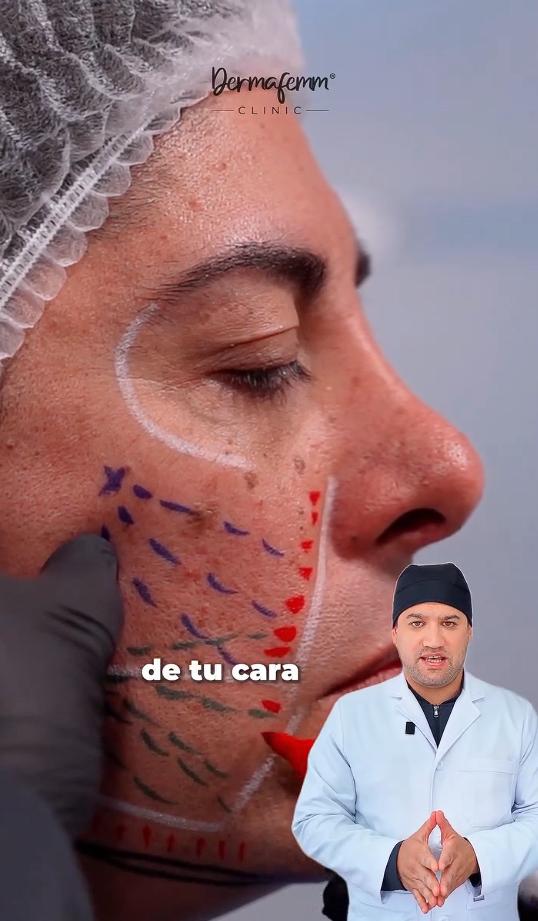 Botota Fox mostró su nuevo procedimiento en el rostro | Crédito: Instagram @dermafemm_clinic