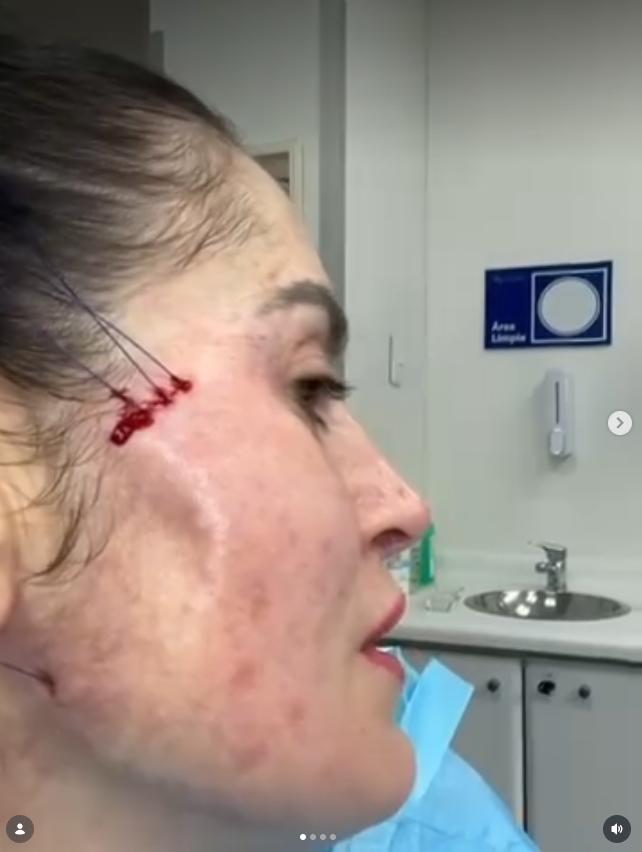 Adriana Barrientos mostró el procedimiento facial que se realizó | Crédito: Instagram @leonabarrientos1