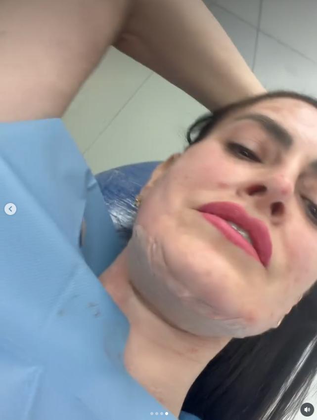 Adriana Barrientos mostró el procedimiento facial que se realizó | Crédito: Instagram @leonabarrientos1