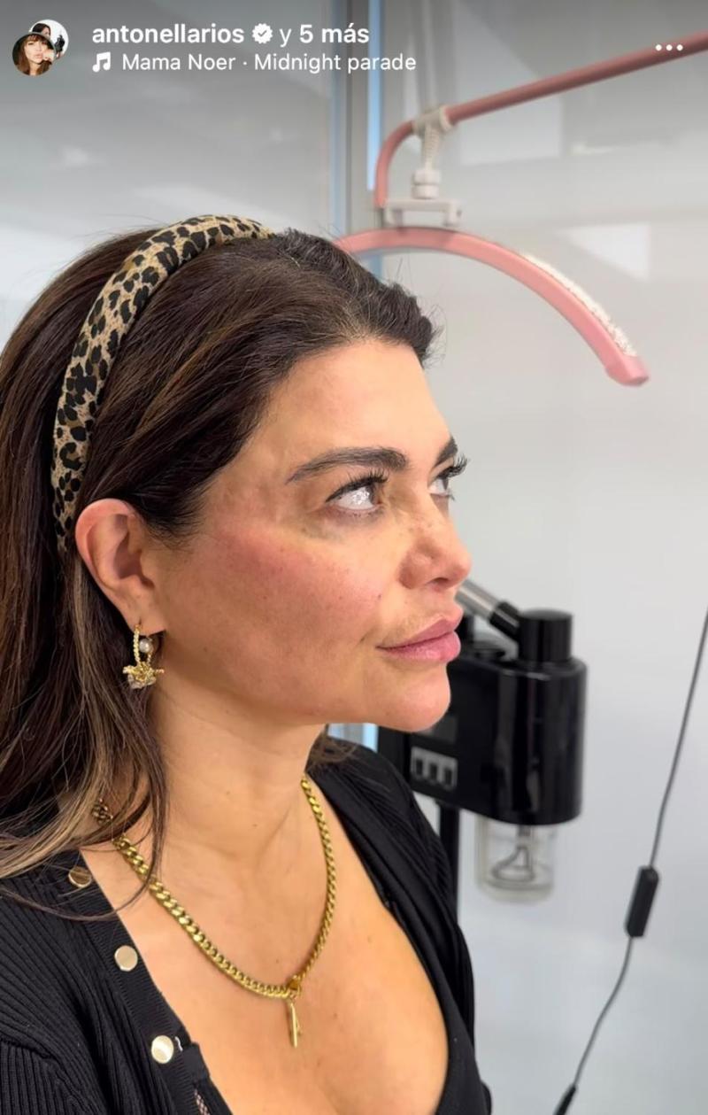 Resultado de Antonella Ríos tras intervención en el rostro - Instagram
