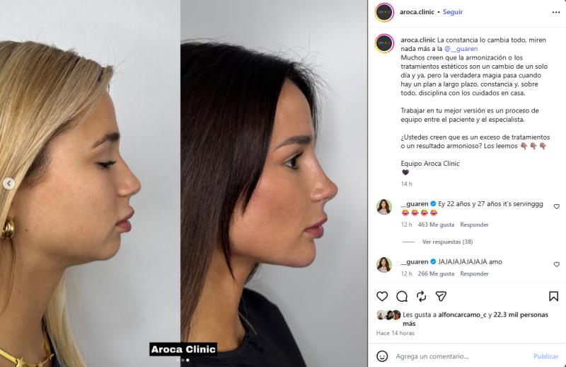 Viralizan antes y después de los procedimientos estéticos de la Guarén | Crédito: Instagram @aroca.clinic
