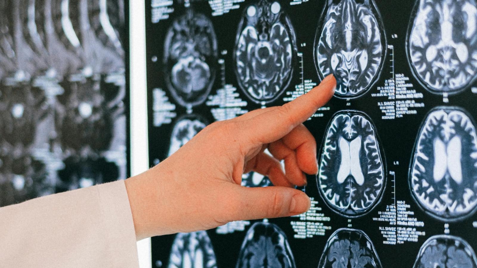 La dieta que ayudaría a frenar el envejecimiento del cerebro - Créditos: Pexels