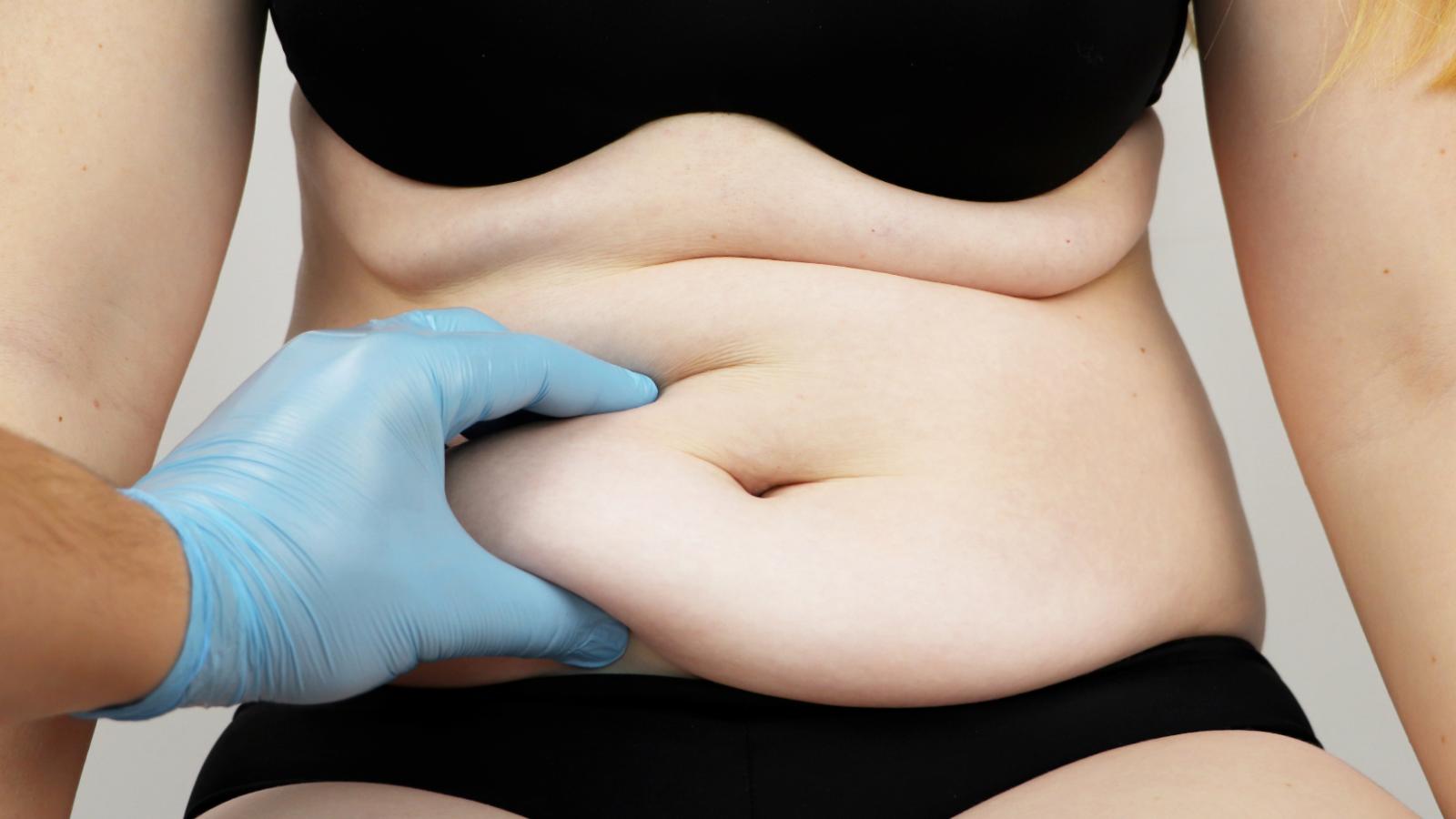 Bono PAD para “guatita de delantal”: cómo acceder y cuál es el valor de la cirugía | Pixabay