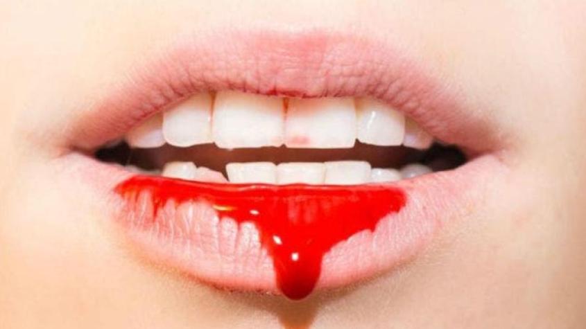 Licantropía clínica y vampirismo: Estas son las enfermedades que llevan nombre de los monstruos de Halloween