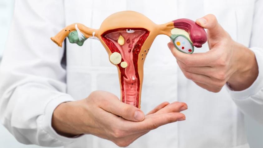 Día de la Endometriosis: qué es y cómo afecta a la salud de las mujeres