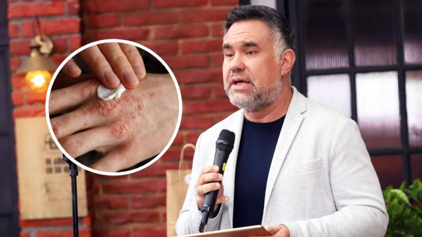 ¿Qué es la dermatitis atópica? La enfermedad que padece el meteorólogo Gianfranco Marcone 