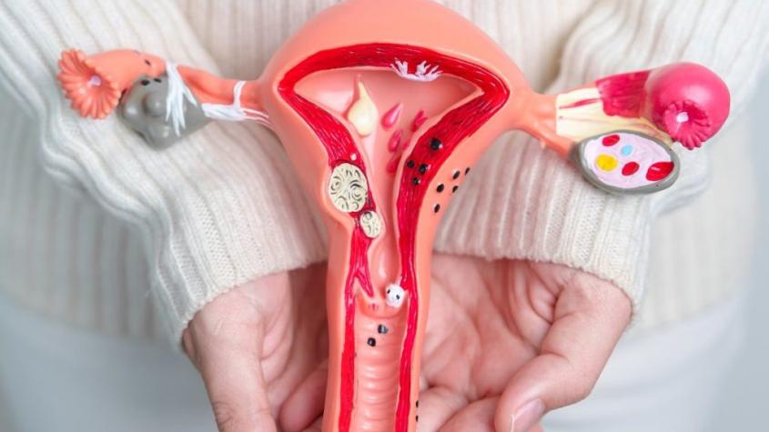 Día Mundial del Cáncer de Ovario: ¿Qué es y cómo prevenirlo?