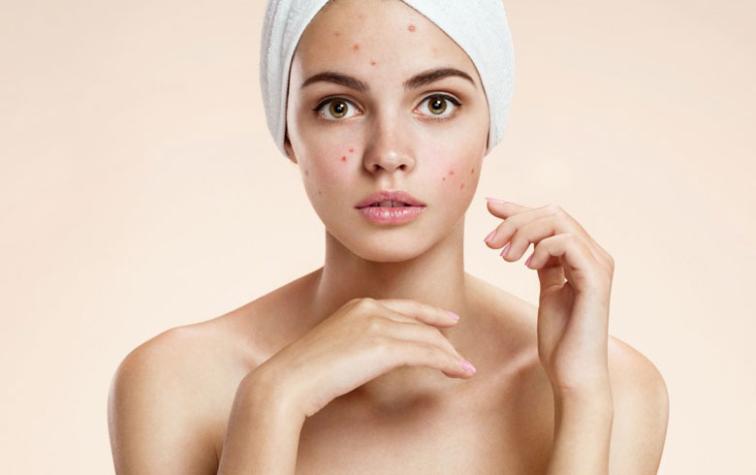 Con estos cambios en tu rutina mejorarás el acné de tu piel 