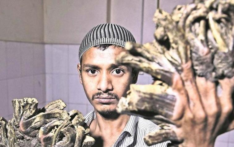 El drama del "Hombre Árbol" no termina: 2 años de tratamiento y 19 cirugías no fueron suficientes 