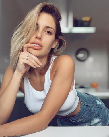 Gala Caldirola luce moretones por inyecciones de ácido hialurónico en rostro