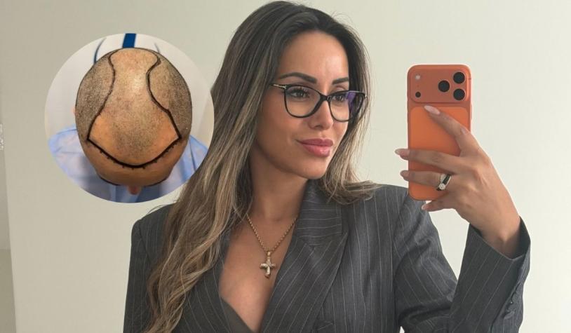 Hermano de Marité Matus se sometió a un implante capilar | Crédito: Instagram @mariteematus - @clinicatotalhair 