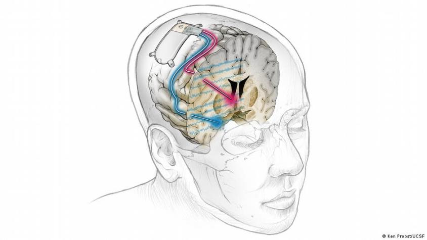 Exitoso el primer implante cerebral del mundo para depresión severa de un paciente