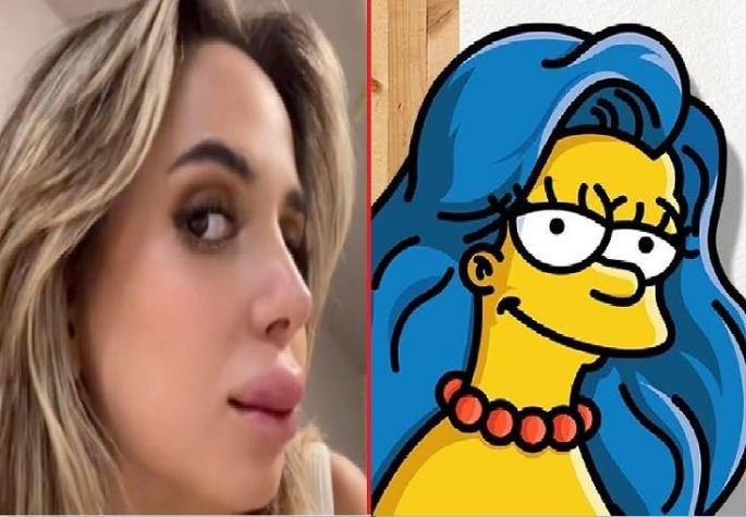 Joven se sometió a un relleno de labios común y ahora es comparada con Marge Simpson