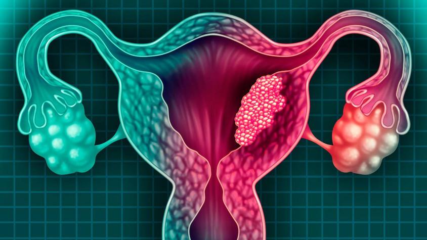 ¿El cáncer de cuello uterino tiene síntomas? Sí, acá te contamos cuáles son las señales para estar alerta 