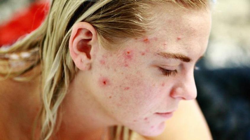 Joven influencer acusa que TikTok cerró su cuenta por mostrar acné quístico que padece