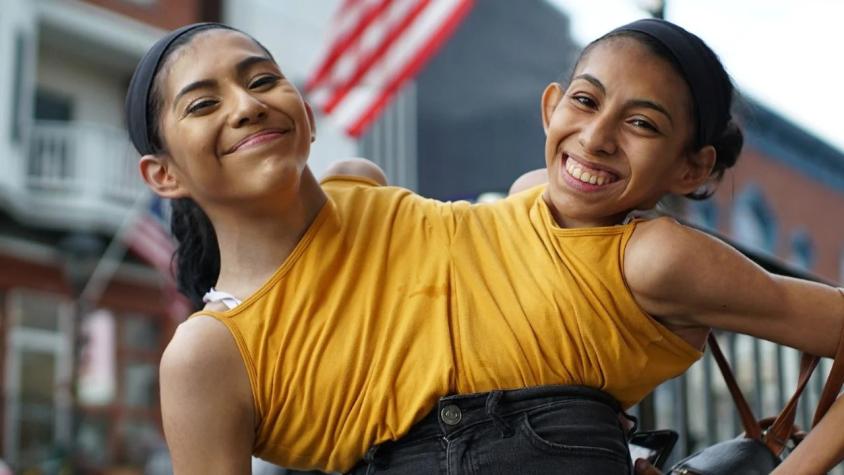 Hermanas llevan 22 años viviendo unidas por el torso y pelvis: Una encontró el amor y la otra se declara asexual