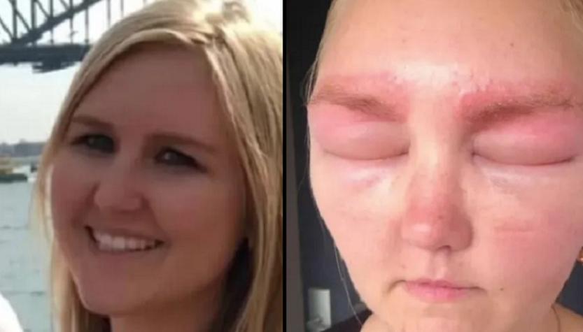 Un desastre: mujer fue a depilarse las cejas y terminó con grave reacción alérgica