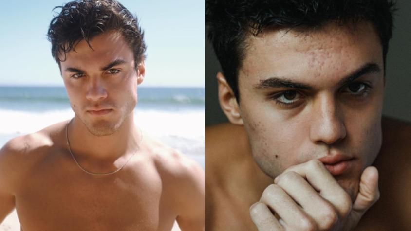 Famoso youtuber se sincera sobre tener acné: “Destruyó mi autoestima”