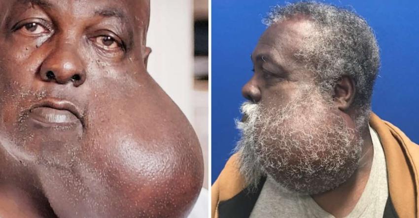 Tenía el tumor "más grande del mundo" y un doctor lo operó gratuitamente