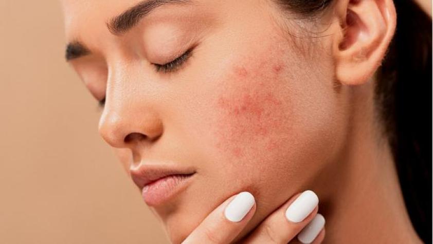 ¿Cuál es el tratamiento más efectivo para el acné? 