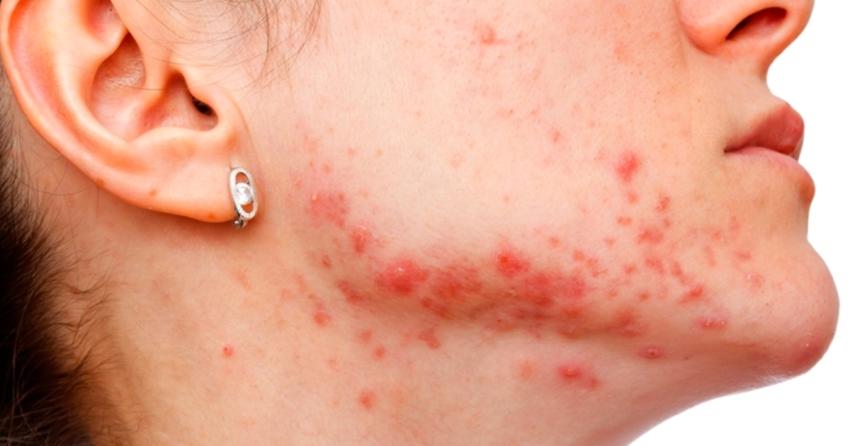 ¿Cuál es la direrencia entre acné y rosácea?
