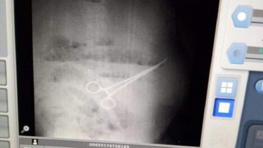 Trabajador murió tras negligencia médica: Dejaron una tijera en su estómago 