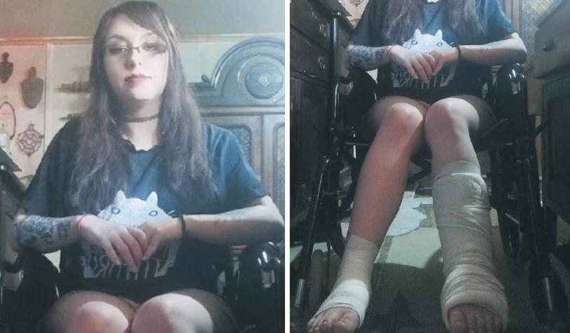 “Ahora no puedo caminar”: se fracturó el pie derecho, pero le operaron el izquierdo