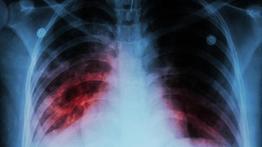Alerta por caso de tuberculosis en colegio de La Florida: ¿Qué síntomas presenta esta enfermedad?
