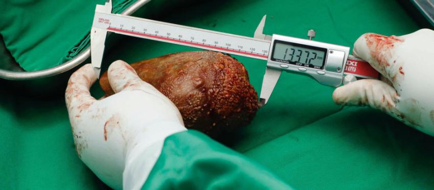 Extirpan el "cálculo renal más grande del mundo" a paciente de 62 años: Medía 13 centímetros