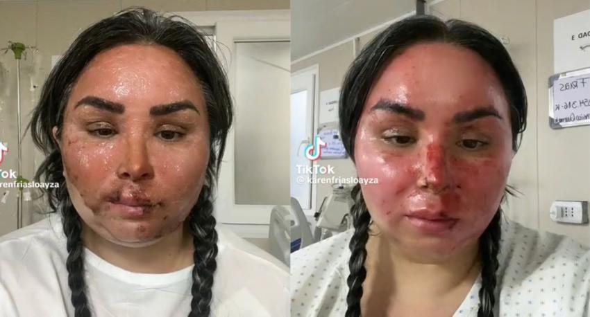 Influencer Karen Frías comparte imágenes de cómo luce su rostro tras accidente con olla a presión