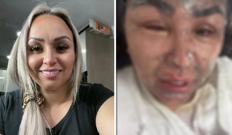 A influencer le explotó una olla a presión en la cara y terminó con graves quemaduras