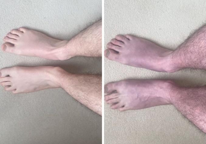 Piernas se ponen azules: descubren nuevo extraño síntoma asociado al "Covid largo"