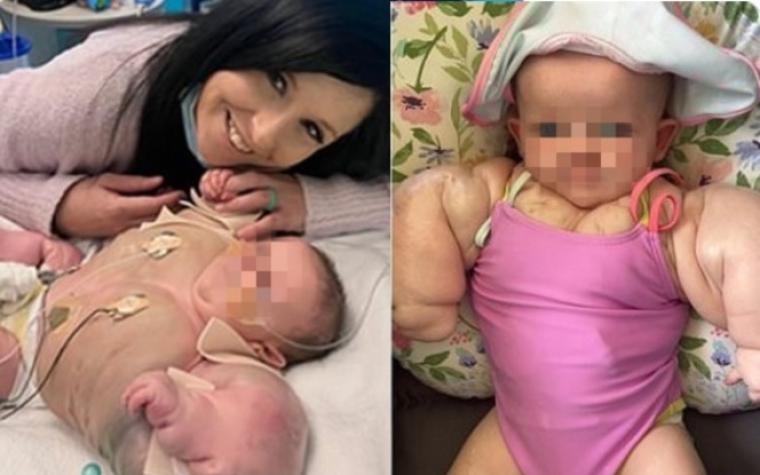 Es apodada como "Baby Hulk": Bebé nace con pecho y brazos muy hinchados