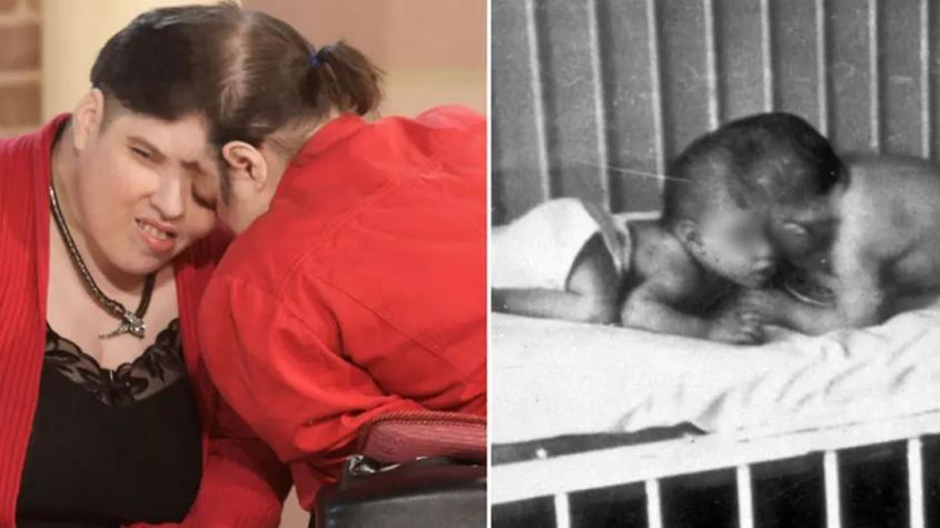 Gemelos Siameses más longevos del mundo fallecen a los 62 años